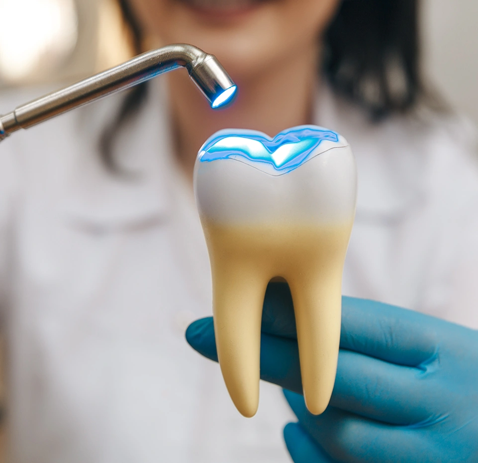 Tooth with a loose filling treated at Dentist Wandsworth